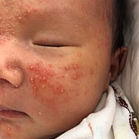 宝宝半个月长了好多新生儿痤疮 不知道怎么办 有没有宝妈遇到过类似的情况 求办法 急急急！