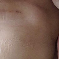 剖妇产第四十天，刀疤微红色不平整怎么回事，是不是没有缝合好？涂抹什么药膏好，还有束着的妊辰纹妈妈...