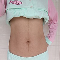 顺产一个星期后的肚子，宝宝出生是6.2斤，肚子感觉和孕前没什么区别，就是松松软软的，坚持绑上束腹带，...