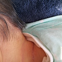 宝宝脖子上折痕有点烂掉了，是什么原因啊 怎么能治好呢