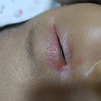 宝宝眼睛长了一圈红红的 有时还起壳