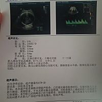即使大家好奇我就贴上我的B超单，3月8号是我生产当天的，生男生女几率都是各一半，数据并不是百分百准确...
