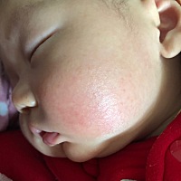 宝宝脸之前长湿疹，现在好了，摸着是光滑，但是看着有纹路一样，以后会变好吗