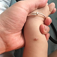 宝宝一岁了，起了好多这个小疙瘩，有没有宝妈知道这是什么的