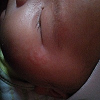 宝妈们宝宝这长的是热气疹还是湿疹擦什么好得快、刚生出来脸上干干净净的现在长大一点反而长了😭