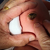 我家宝宝肚脐眼下面里面翻起来有点流脓，洗澡完之后估计她奶奶没有擦干，这个是要发炎还是已经发炎了呢？