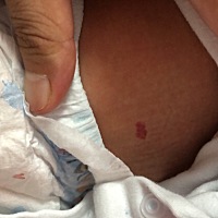 有宝妈孩子身上和嘴唇上有血管瘤的么？怎么治疗，交流下经验