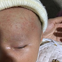 宝宝长这么多红红的东西会是什么原因引起的呢？最近没吃什么上火的东西呀？要买什么药涂涂吗？求解有同...