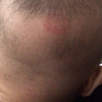 宝宝头上红了一块是怎么回事，有半个月还不见好，有宝妈知道吗？