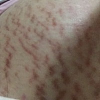 第一胎不懂怎么保养，肚子撑开得好厉害