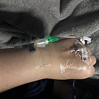 36周➕ 羊水少 住院打点滴3天 每天8小时➕ 两只手都肿了🤕然而 羊水还是越来越少  催产针 除了手痛 没...