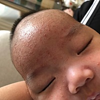 这湿疹真的是要逆天了，反反复复的，试了好几种药膏都不见好，宝妈们有遇到这样的吗？