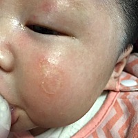 1个多月的宝宝脸被抓。原本只是一条痕，现在变成一大块，请问这样会留疤吗？