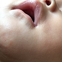 有宝宝出现这样情况吗，原本像湿疹是红色的，现在变白色了，摸起来有点像结痂的硬度～