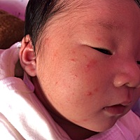 宝宝二十多天了脸上一直长痘痘，能抹药不，有宝妈知道为什么长痘吗