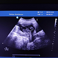 5个月b超看的男孩 会翻盘吗