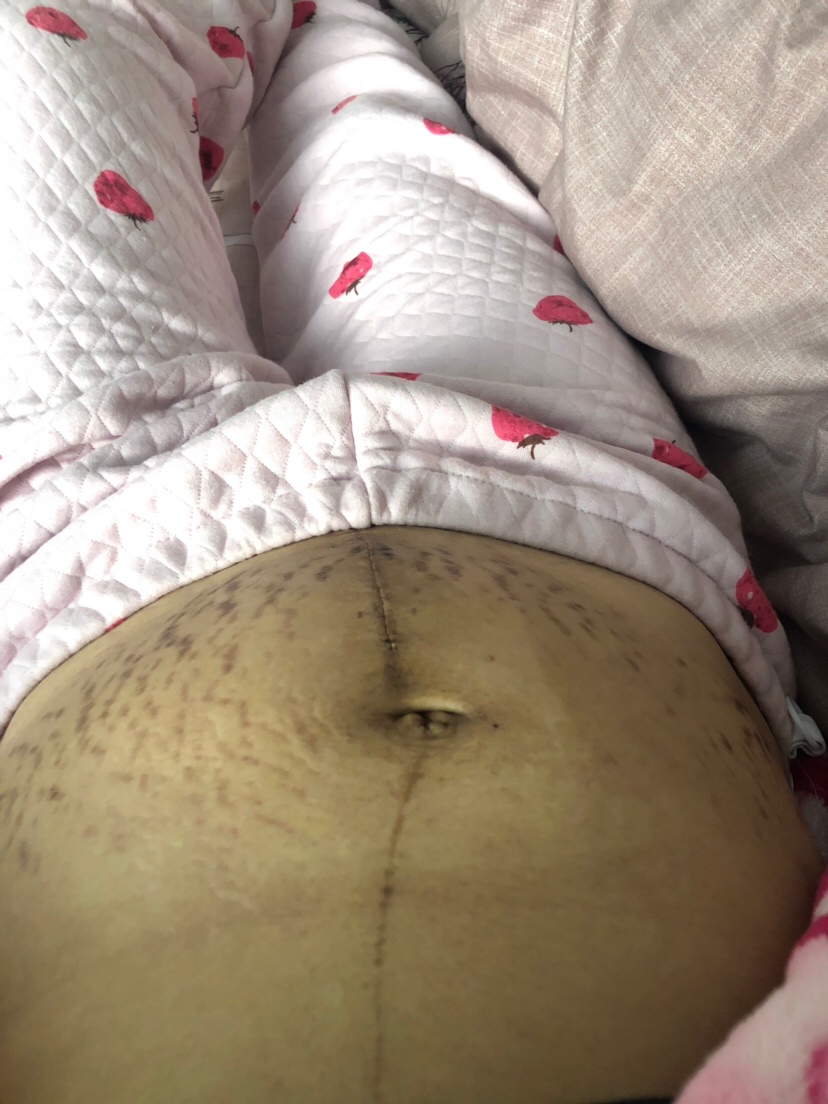 生完孩子肚子彻底毁了……