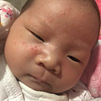 宝宝22天了 湿疹了 跪求 有没有过来的宝妈分享经验