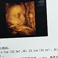 24周四维左侧侧脑宽1CM。有遇到过一样情况的宝妈吗？