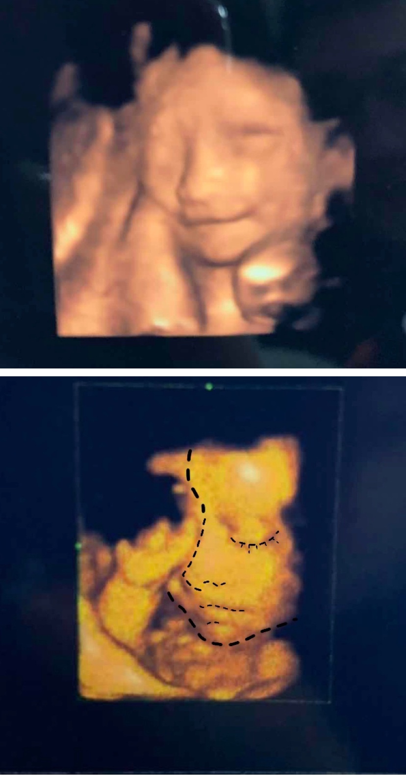 医生说眉眼长的像我，笑起来跟老公一摸一样。我们俩的结合体