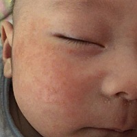 宝宝湿疹反反复复怎么办呀，去医院也不管用，心急死了，我没有宝妈有啥好办法的谢谢了