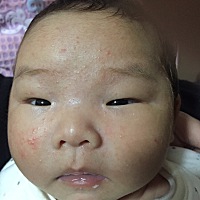 一个多月的宝宝脸上张的这些小米米是什么啊，要摸什么药之类的吗？挺着急的在线等