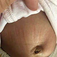 孩子肚脐长了肉芽，抹药一周也不知道怎么才算长好，有宝妈知道吗