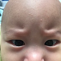 求急！宝宝长的这是什么？一个多礼拜了也不见好，以为是湿疹抹了药膏没效果，这几天越想越多也消不掉，...