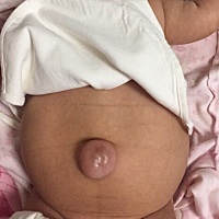 记录宝宝两个月时的脐疝，好吓人，好心疼，不过现在已经好多了，我从网上给宝宝买的脐疝带，只要继续再...
