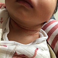 宝宝脖子上这个是湿疹吗？宝妈们有没有好的办法，谢谢赐教！