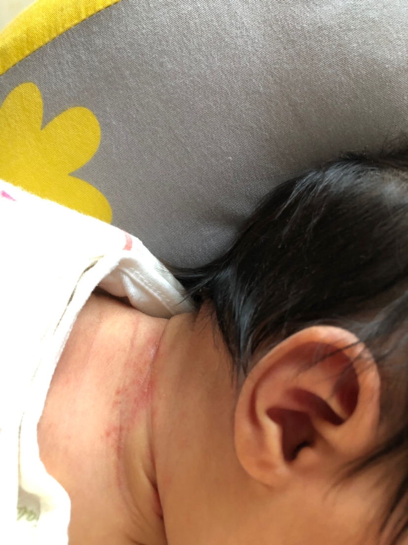 宝宝脖子上这个是湿疹吗？宝妈们有没有好的办法，谢谢赐教！