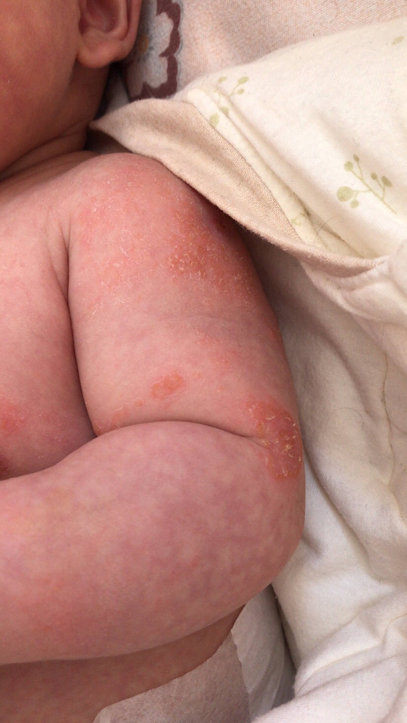 有懂的宝妈帮我看看 这是湿疹吗。之前没有这么多，