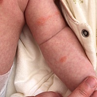 有懂的宝妈帮我看看 这是湿疹吗。之前没有这么多，