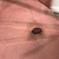 肚脐眼出血了，严重吗这样