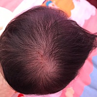 头顶的旋上有好多红点是什么原因