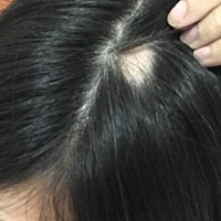 有没有孕期斑秃的亲，晚上洗澡发现头发少了一块，这个会好吗？有没有什么治疗的方法啊