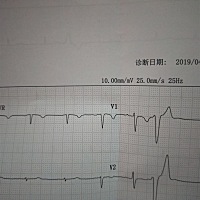 每一次来检查都是很忐忑，今天第二次产检，空腹验血 心电图。心电图显示『室性早搏』。。哎！心情瞬间不...