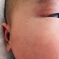 两个多月的宝宝，脸上长白色的小疙瘩，像脂肪粒一样，要紧吗？