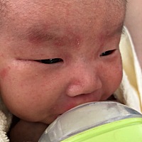 宝宝脸上起的什么东西