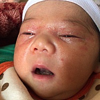 宝宝眼周围是什么，有遇到相同情况的宝妈吗？ 刚开始眼角一点红,然后擦了医院配来的红霉素眼膏，没怎么...