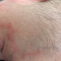 宝宝湿疹总是反反复复，擦了药膏好了，没过一会又有了，请问有什么更好的办法吗？，