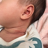 宝宝的脖子最近老这样，这一边严重，另一边好些，求圈里的宝妈指点，该怎么处理，现在就只有清水擦擦，...