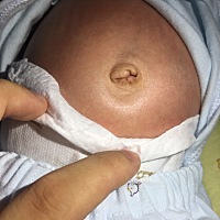 前面肚脐已经差不多好了，今天发现有点血干，正常吗？