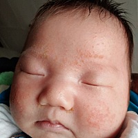 宝宝脸上好多湿疹挺严重的，擦什么药呀