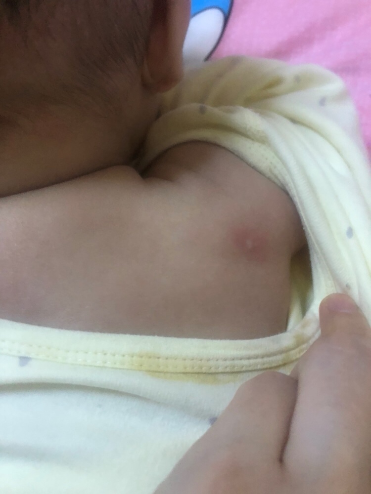 有谁知道这是长的什么，早上背上长了很多擦了之前擦湿疹的膏子 早上长的好了，别的地方又开始长了，今天一天都是这样反反复复，擦了地方又好别的地方又长，不知道长的是什么？但可以肯定的是跟之前的湿疹长的是不一样的，有谁知道长的什么？？？