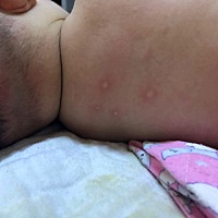 有谁知道这是长的什么，早上背上长了很多擦了之前擦湿疹的膏子 早上长的好了，别的地方又开始长了，今天...