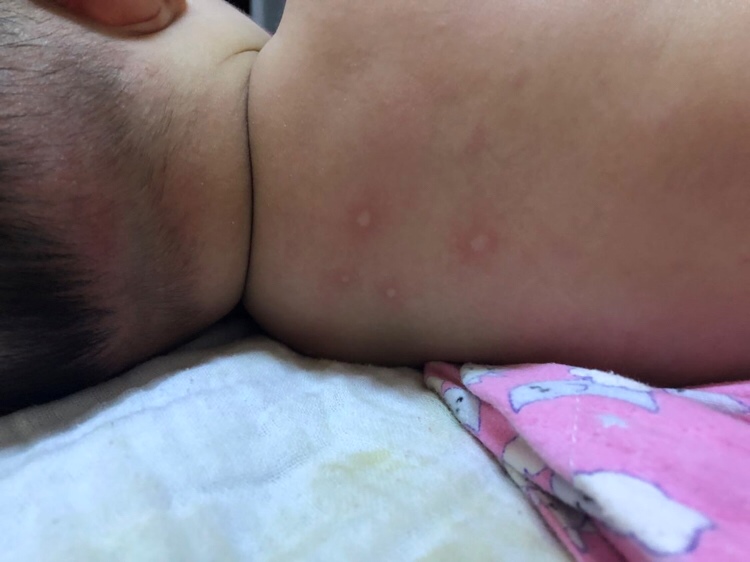 不知道宝宝身上长的什么？上午擦了之前湿疹的膏子早上长的地方都好了，别的地方又开始长了，今天一天都是这样反反复复，擦的地方好了别的地方又开始长了，不知道这长是什么？但可以肯定的是跟之前的湿疹长的是不一样的，宝宝是四个月五天，今天没有去抓也没有哭和平时一样的反应，有谁知道这长的是什么？？总是这样反反复复十几分钟擦了的地方好但别的地方又开始长。