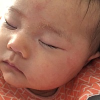 宝宝脸上脱皮，会痒，手一直抓是穿太多太热吗，不过感觉他手冰凉的，又一直打喷嚏，又不好少穿衣服。看...