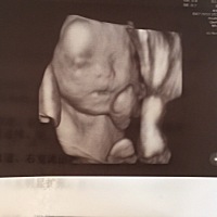 请问有人知道四维照片里，我宝宝的头上为啥有个看起来像大包的区域么？有没有问题呀？各项数据都挺正常的