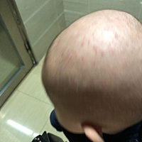 湿疹发作 老抓  有啥湿疹妙方